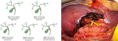 Biliary Strictures and Cholangiocarcinoma – Untangling a Diagnostic Conundrum